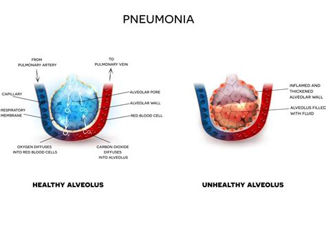 Chlamydia Pneumoniae Symptoms Types Diagnosis Treatment