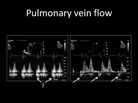 Doppler Contrast Echocardiography Intechopen