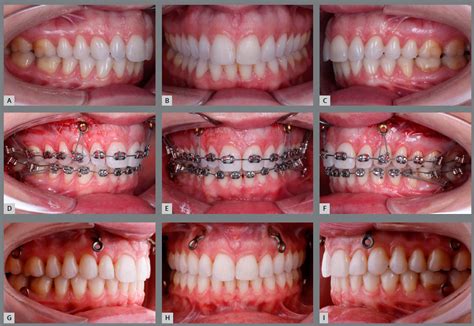 Scielo Brasil Intrusion Of Posterior Teeth Using Miniplates