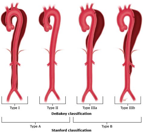 Patologia Dellaorta Toracica E Toraco Addominale Chirurgia Vascolare