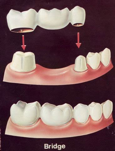 Bridge ( Fixed & Partial Dentures ) at best price in Chandigarh by Dentition-Advanced Dental ...