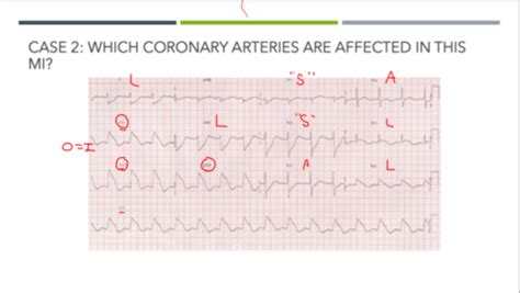 Can't Miss ECG Dx Flashcards | Quizlet