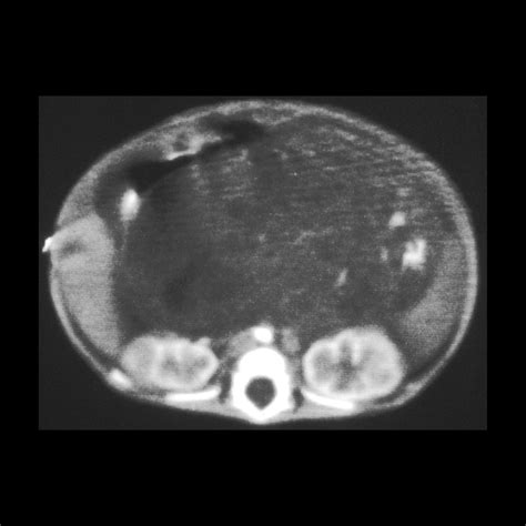 Newborn With Midline Abdominal Mass Pediatric Radiology Case