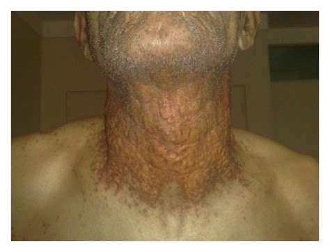 Involvement Of Flexural Regions Of Neck With Papule That Confluent To