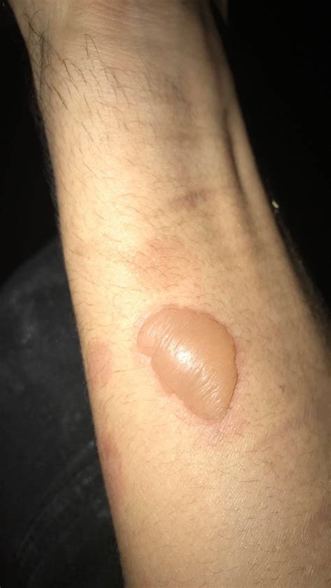 Got This Blister From Grease Burn At Work The Skin Is Thin And Its