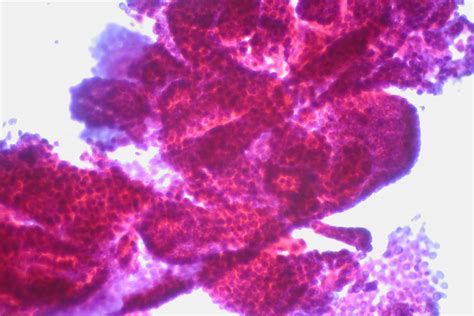 Papillary Thyroid Carcinoma Fna Rapid Pap Stain Complex Flickr