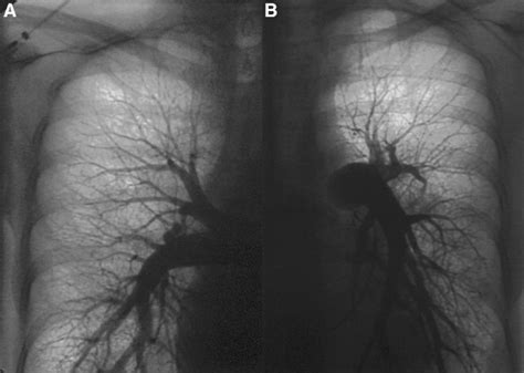 A Right And B Left Selective Pulmonary Angiograms From The Patient