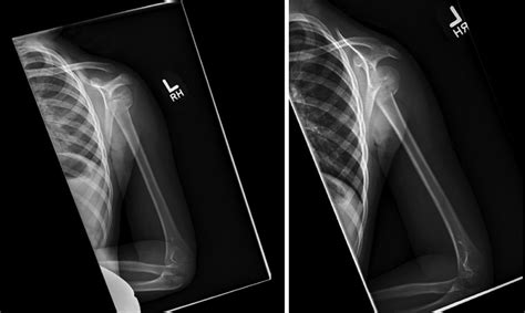 Salmonella Osteomyelitis In A Pediatric Patient With A Proxi Jbjs