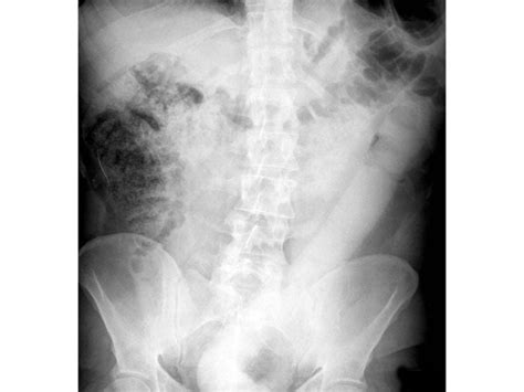 New Tool Was Invented To Remove A Inch Dildo From Mans Rectum Boldsky