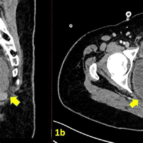 Contrast Enhanced Ct Scan Pelvis A Sagittal Section Showing