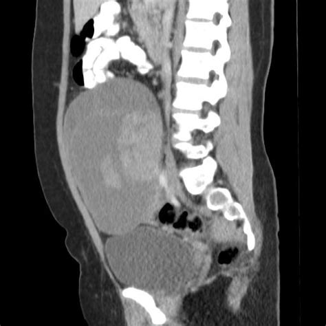 Serous Ovarian Cystadenocarcinoma Image