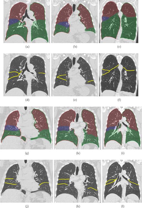 Figure From Automatic And Interactive Segmentation Of Pulmonary