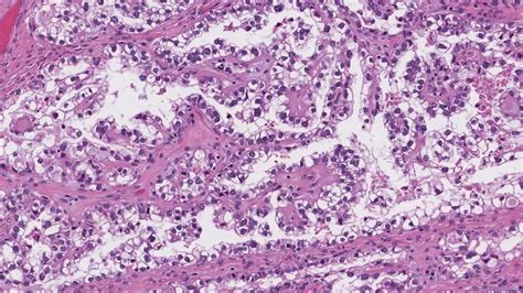 Clear Cell Carcinoma Of The Ovary Ottawa Atlas Of Pathology