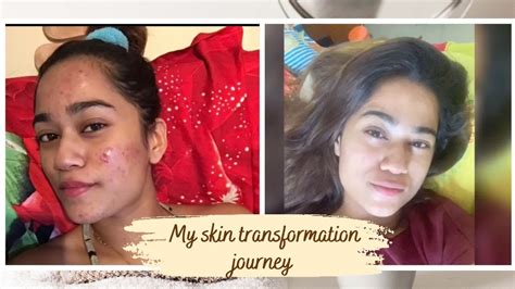 My Skin Transformation Journey Acne And Acne Scars Shriya Jain Youtube