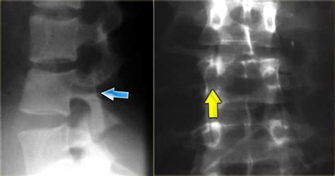 The Radiology Assistant Spine Thoracolumbar Injury