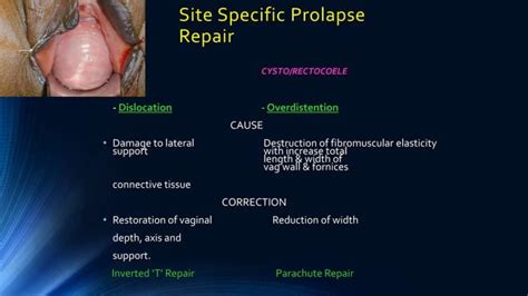 Vault Prolapse Pelvic Organ Prolapse Supports Of Uterus Ppt