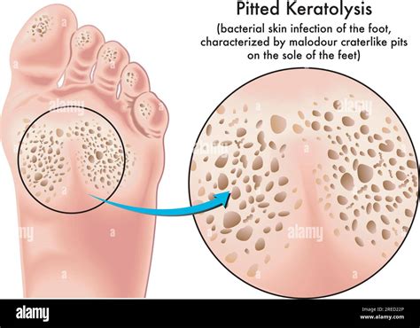 Medical illustration of symptoms of pitted keratolysis, a bacterial ...