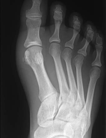 Acute Calcific Periarthritis Radiology Case Radiopaedia Org