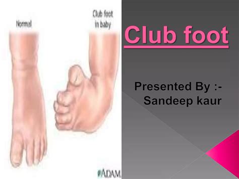 Club foot | PPT