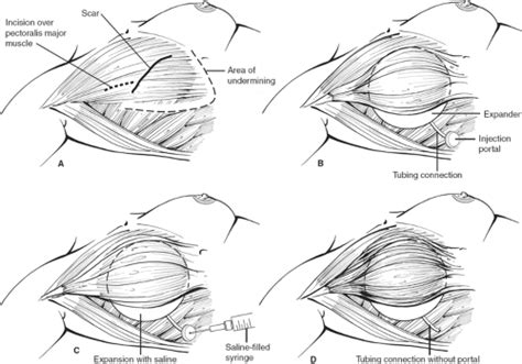 Soft Tissue Reconstruction With Flap Techniques Basicmedical Key