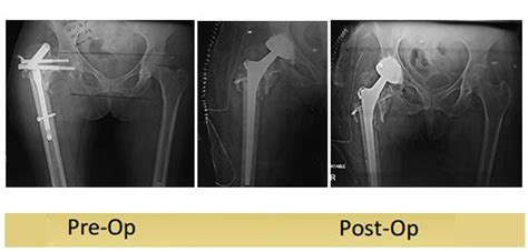 Revision Total Hip Replacement Dr Shekhar Agarwal