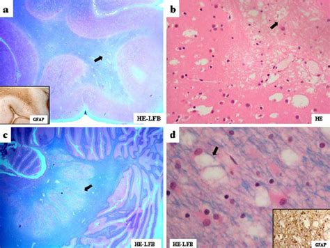 Brain Histopathology Of Patient A Section Of Cerebral Cortex And