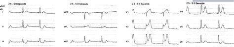 Dr. Smith's ECG Blog: De Winter's T-waves are Not a Stable ECG condition. Upright T-waves in ...