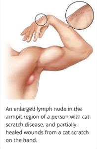 Cat Scratch Disease CSD Or Bartonellosis