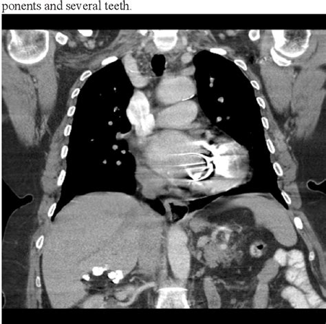 Pdf Primary Mature Cystic Teratoma Of The Liver Report Of A Rare