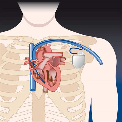 New Pacemaker Generates Electricity From Heartbeats To Power Itself