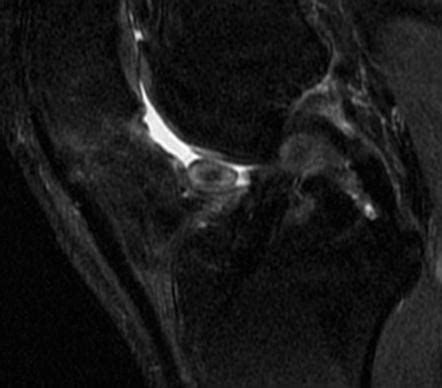 Cyclops Lesion Image Radiopaedia Org