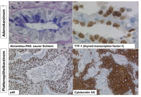 Pathologie Vorlesungen Flashcards Quizlet