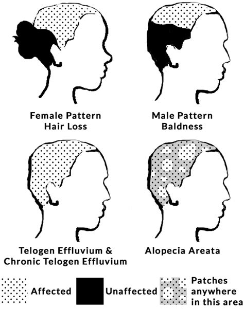 Stress Related Hair Loss