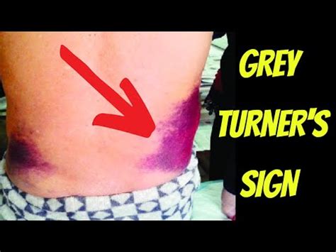 Grey Turner's Sign & Retroperitoneal Haemorrhage Explained | Doctor O ...