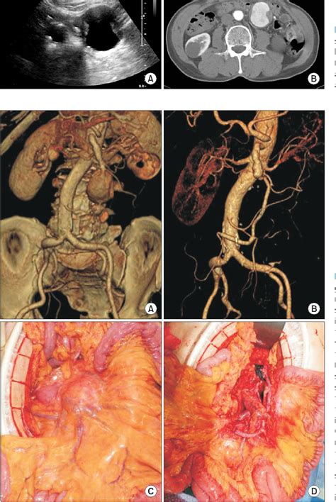 Figure 1 From A Case Of Superior Mesenteric Artery Aneurysm Mimicking