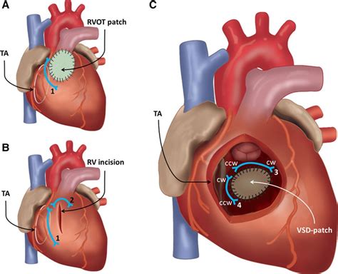 Left Sided Ablation Of Ventricular Tachycardia In Adults With Repaired