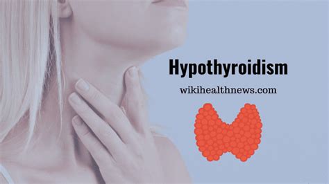 Hypothyroidism Underactive Thyroid Gland Wiki Health News