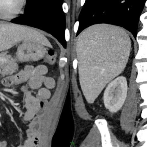 A Year Old Man With Biopsy Proven Aggressive Sm A B Coronal