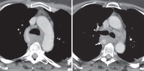 Blunt Thoracic Trauma Radiology Key