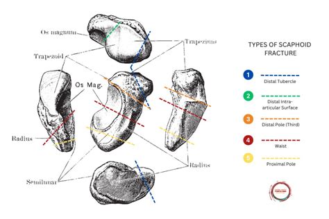 Understanding Scaphoid Fractures A Comprehensive Guide To Diagnosis