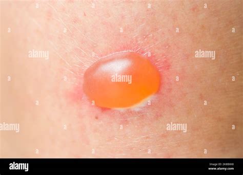 Dermatology And Skin Conditions Blister On Skin Of An Asian Woman Due