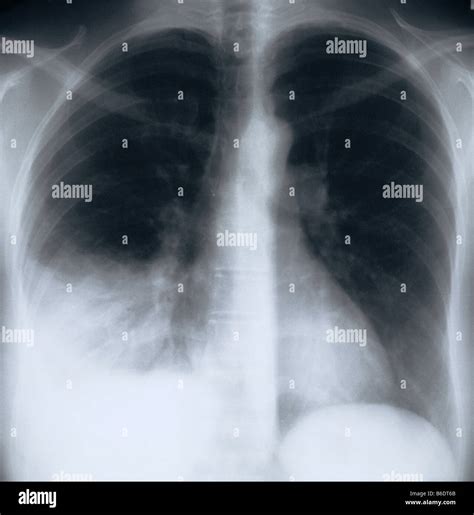 Bacterial Pneumonia X Ray