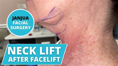 Neck Lift Platysmaplasty After Facelift Dr Tanveer Janjua New