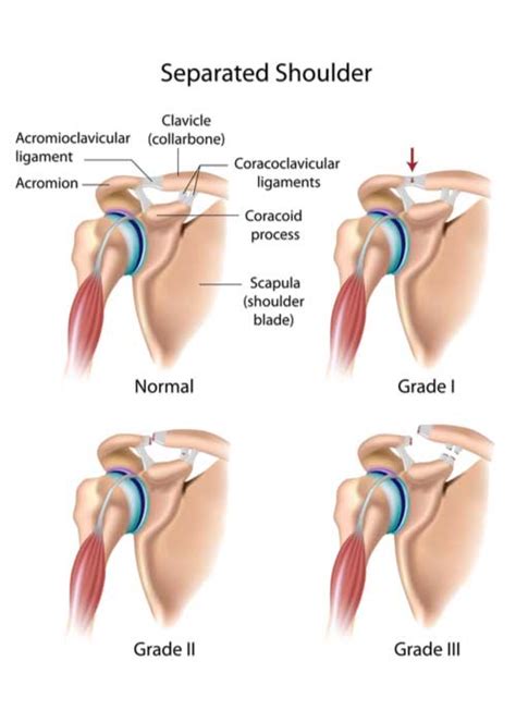 AC Joint Injury | Separated Shoulder | CC Joint Injury | Orthopedic ...