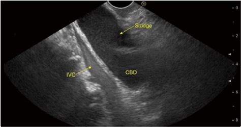 Linear Endoscopic Ultrasound From The Duodenal Bulb Shows Echogenic Download Scientific Diagram