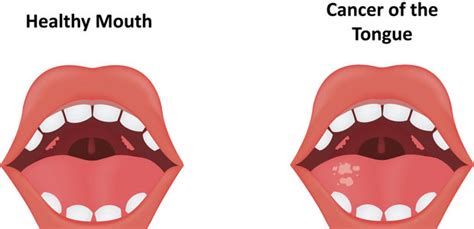 Tongue Cancer | Modern Cancer Hospital Guangzhou, China