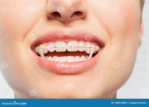 Female Mouth With Orthodontic Elastics On Braces Stock Image Image Of