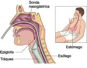 Cuidados de las Sonda Nasogástrica Instituto Quirúrgico de Andalucía IQA