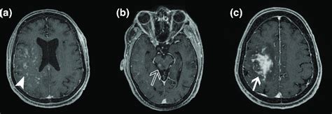 (a) The axial view of contrast MRI scan of the brain showing multiple ...