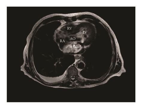 Chest Magnetic Resonance Imaging Showing Invasion And Subtotal